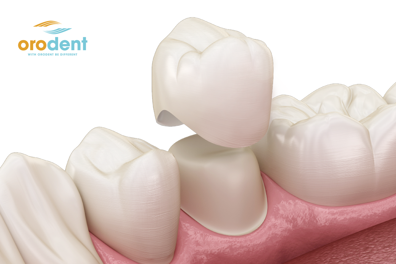 [ THẮC MẮC ] Răng sứ Orodent có tốt không?